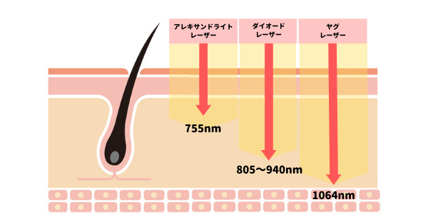 医療レーザー脱毛の機種による波長のちがい