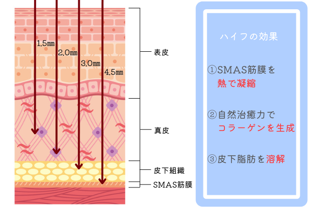 ハイフ　仕組みと効果