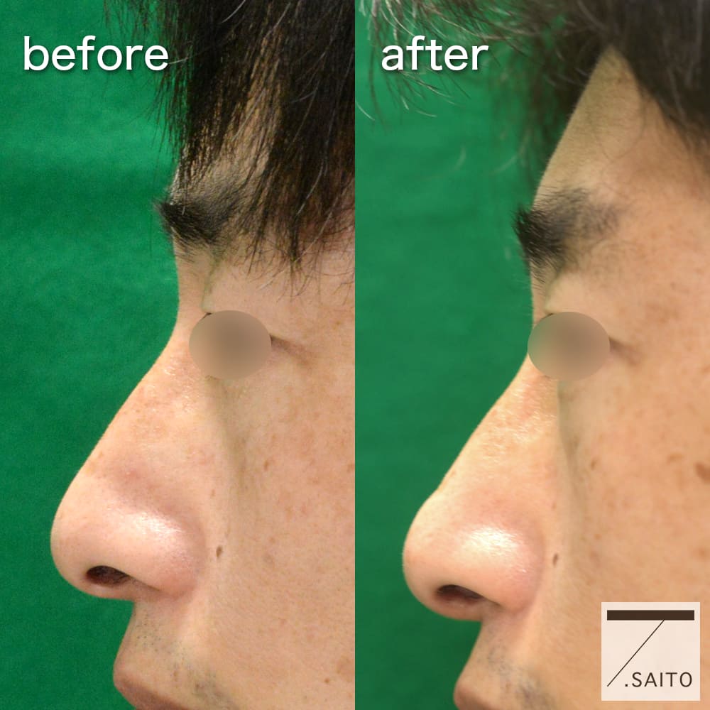 曲がった鼻 斜鼻の治療を ２ステップで 目で見て 理解する 新さっぽろウィメンズ ヘルス ビューティークリニック