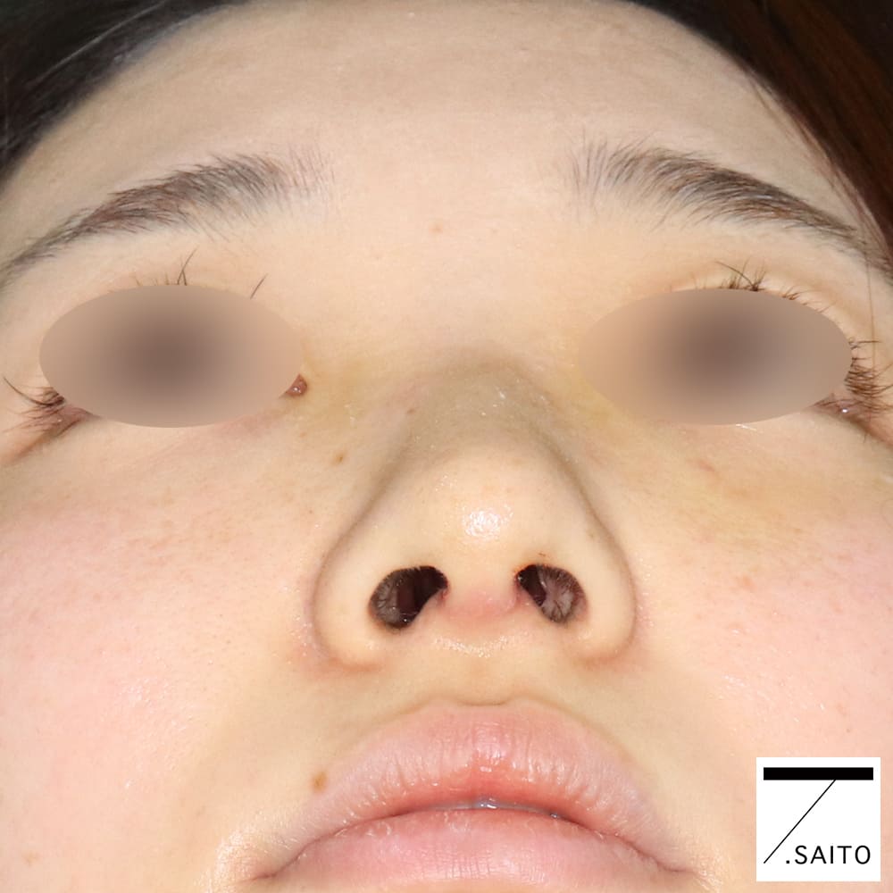 斜鼻 曲がった鼻の手術ってどんな流れ 術前相談 術後１週間を公開 新さっぽろウィメンズ ヘルス ビューティークリニック