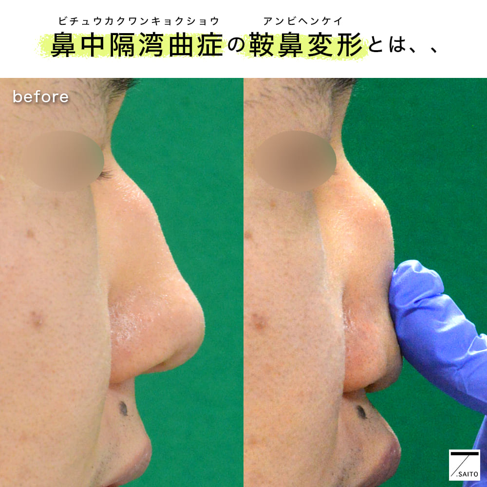 鞍鼻あんび変形とは 美容鼻手術 斜鼻手術や骨折のトラブルについて 新さっぽろウィメンズ ヘルス ビューティークリニック