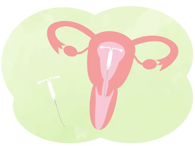 IUD　子宮内避妊具