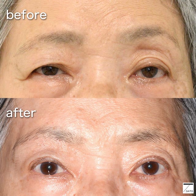 まぶたのたるみは眉毛から 目元は３ステップ治療で劇的に改善する 新さっぽろウィメンズ ヘルス ビューティークリニック