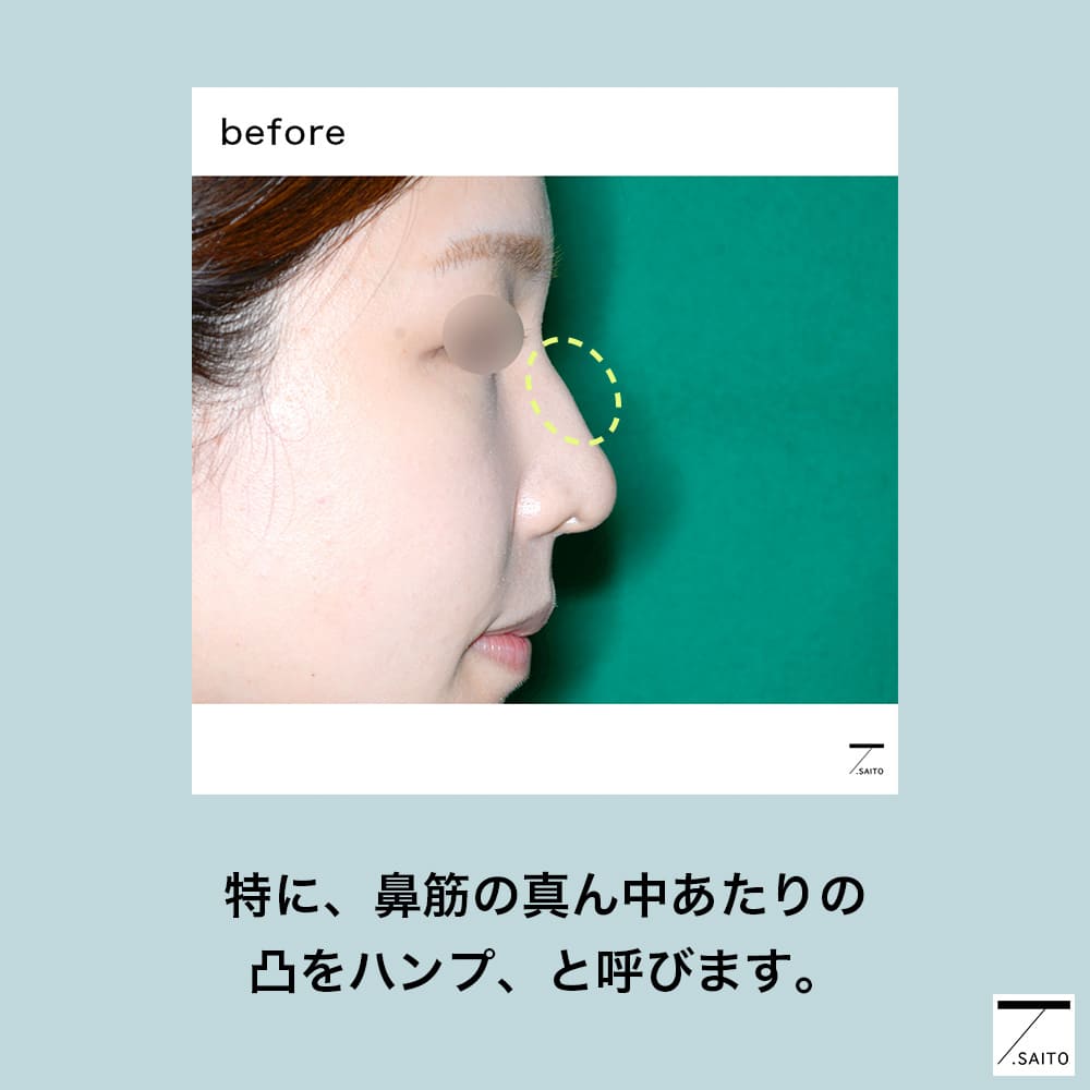 わし鼻の修正手術 プロテーゼ無しで鼻筋を整形したい人の２大ポイント 新さっぽろウィメンズ ヘルス ビューティークリニック
