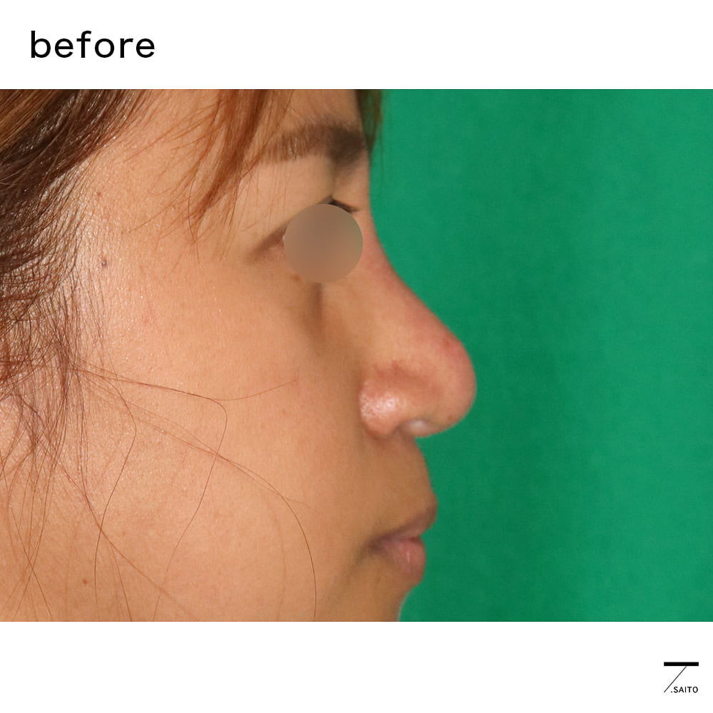 団子鼻の整形手術は名医でも難しい 丸い鼻先のお直し ３つの注意点 新さっぽろウィメンズ ヘルス ビューティークリニック