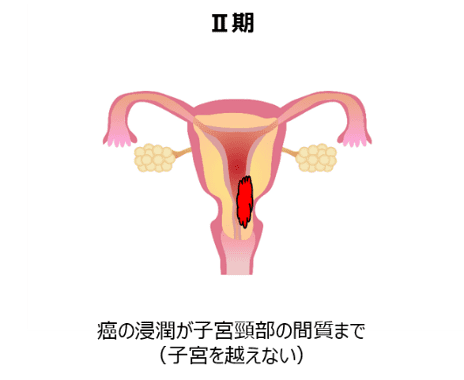 子宮体がん　II期