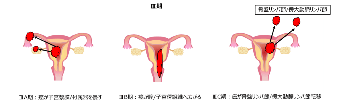 子宮体がん　Ⅲ期