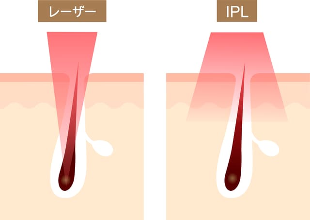 レーザーとIPL