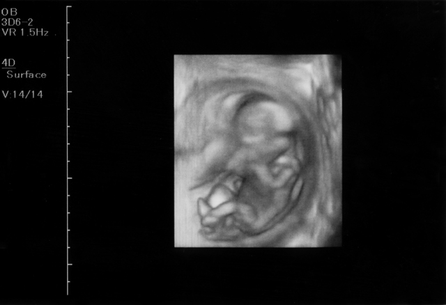 胎児エコー写真
