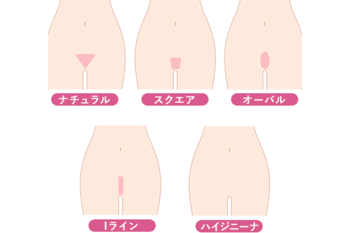 VIO全体を無毛にしなくてもよい
